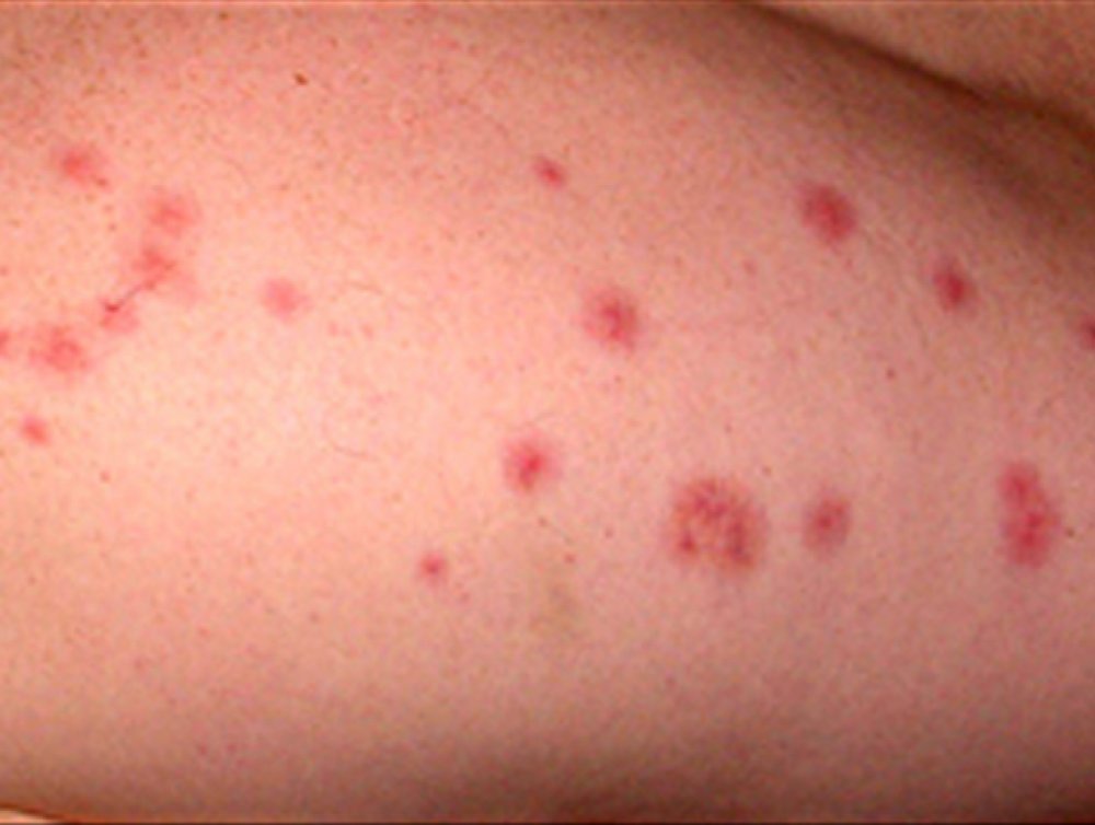 Beware of Bed Bugs